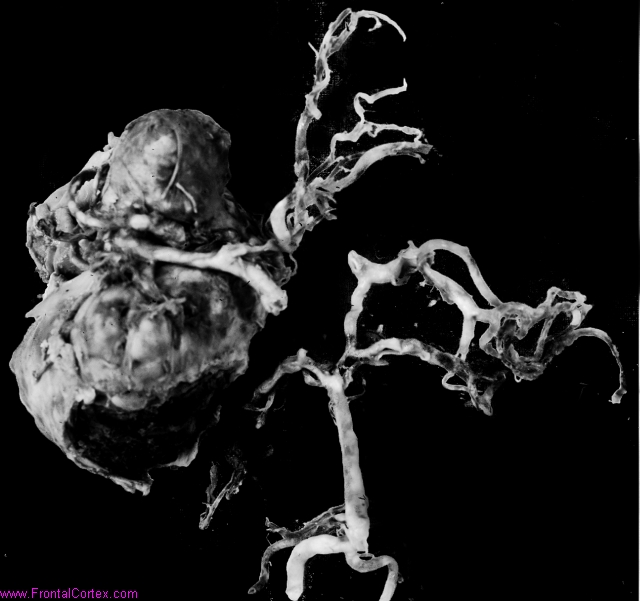 Giant middle cerebral artery aneurysm, unruptured, dissected